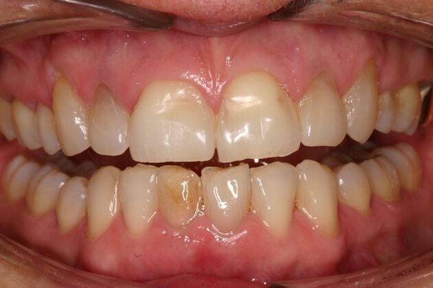 Veneers Joann - Before