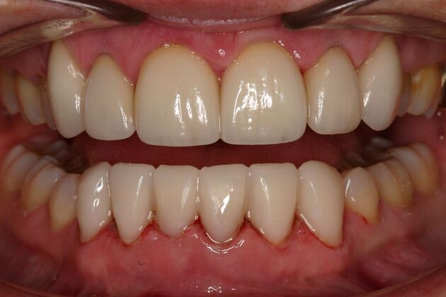 Veneers Joann - After