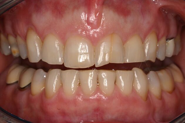 Veneers Joanne - Before
