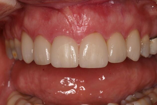 Veneers Joanne - After