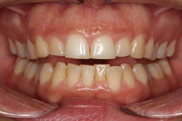 Orthodontics KC - Before