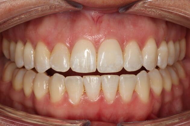 Orthodontics Beth - After