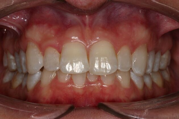 Orthodontics Jennifer - Before