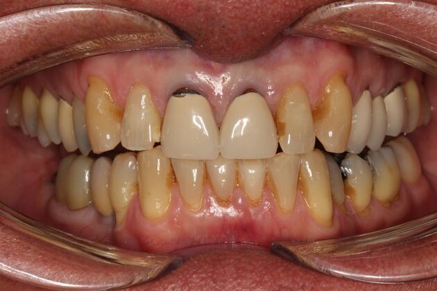 Implant Restorations Greg - Before