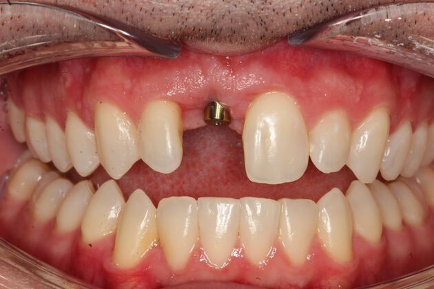 Implant Restorations David - Before