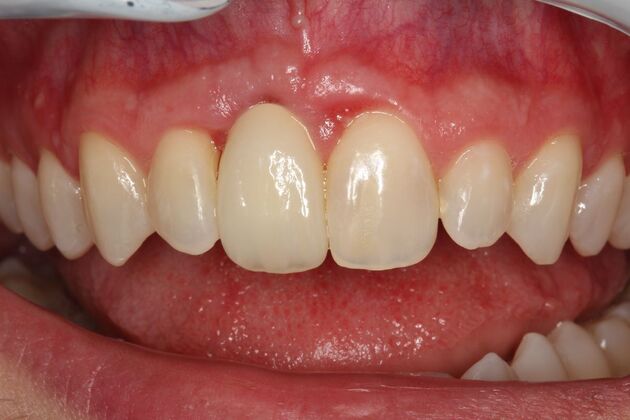 Implant Restorations David - After