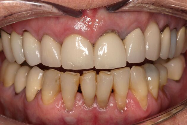 Implant Restorations: Janice - Before