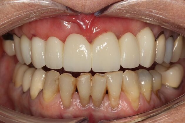 Implant Restorations: Janice - After