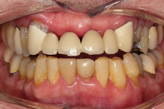 Crowns Dennis - Before