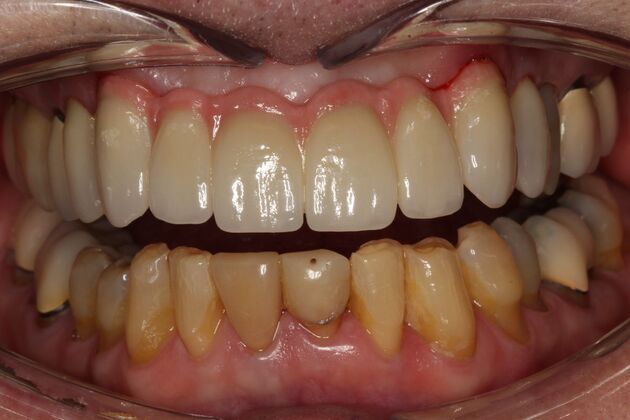 Crowns Dennis - After