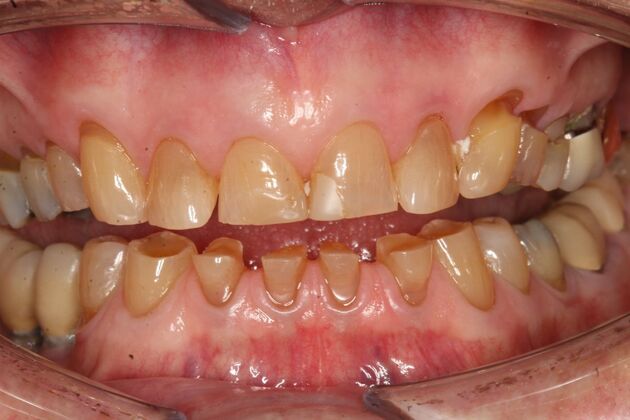 Full Mouth Rehabilitation Horst - Before