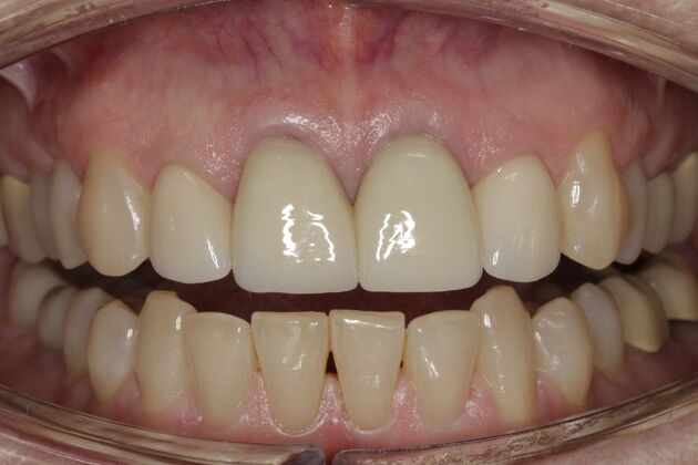 Crowns Cindy - Before