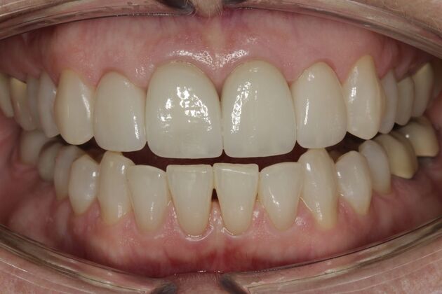 Crowns Cindy - After