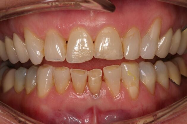 Veneers Pat - Before