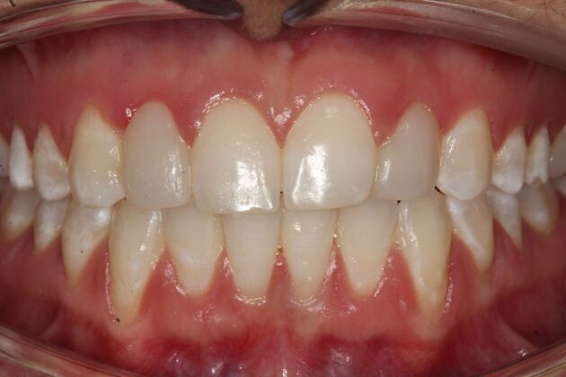 Cosmetic Bonding: Gabrielle - After