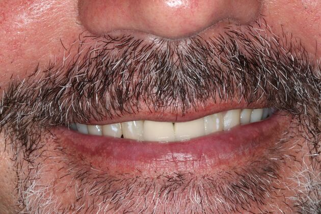 Veneers: Case 28 - After