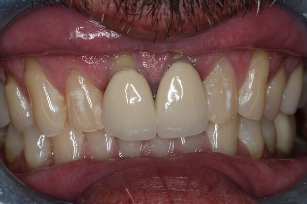 Veneers: Case 28 - Before