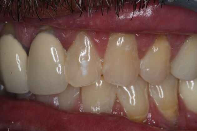 Veneers: Case 28 - Before