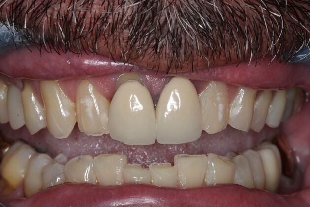 Veneers: Case 28 - Before