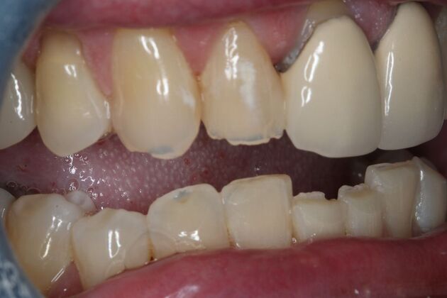 Veneers: Case 28 - Before