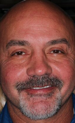 Veneers Case 28 - After