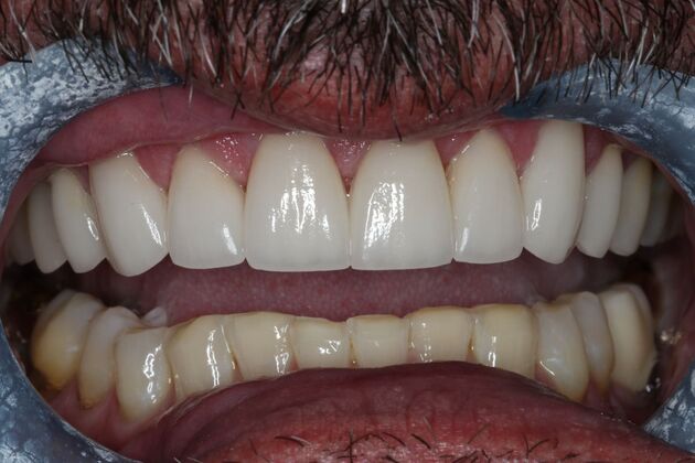 Veneers: Case 28 - After