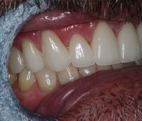Veneers: Case 28 - After