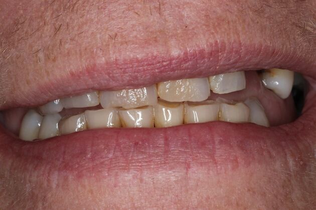 Dentures Case 16 - Before