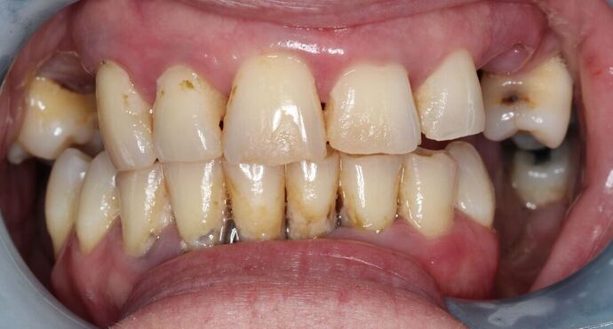 Dentures: Case 16 - Before