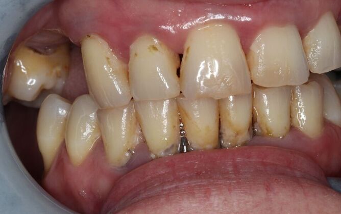 Dentures: Case 16 - Before