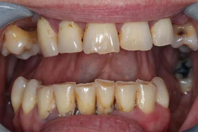 Dentures: Case 16 - Before
