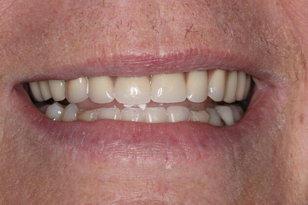 Dentures Case 16 - After