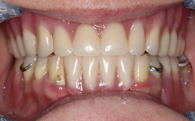 Dentures: Case 16 - After