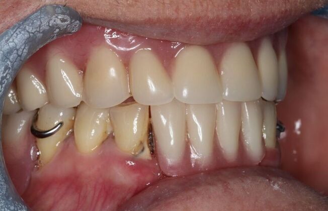 Dentures: Case 16 - After