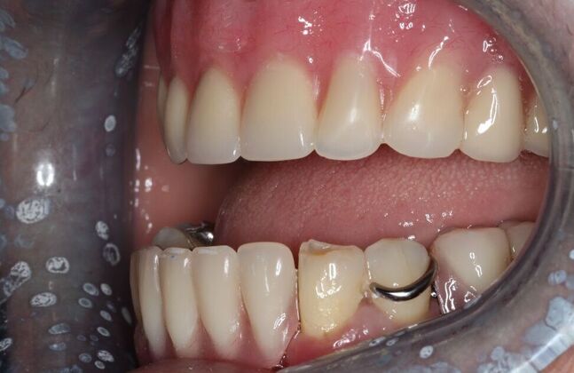 Dentures: Case 16 - After