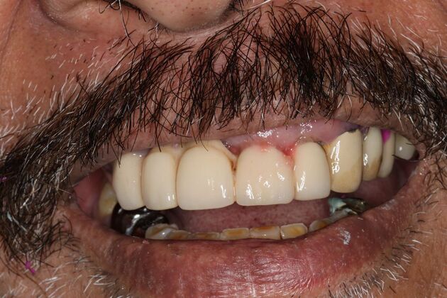 Teeth In A Day Case 25 - Before