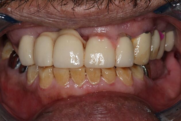 Teeth In A Day: Case 25 - Before