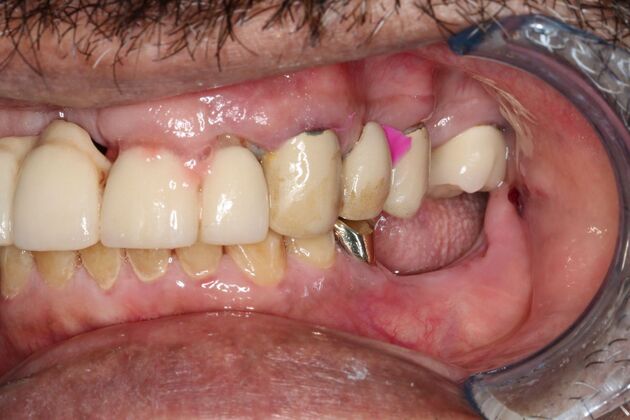 Teeth In A Day: Case 25 - Before