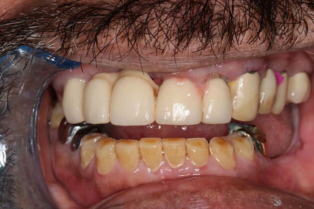 Teeth In A Day: Case 25 - Before