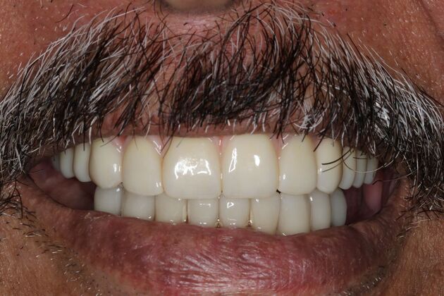 Teeth In A Day Case 25 - After