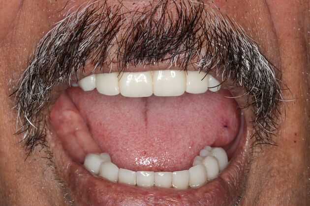 Teeth In A Day: Case 25 - Upper All on 4 and Lower Crowns