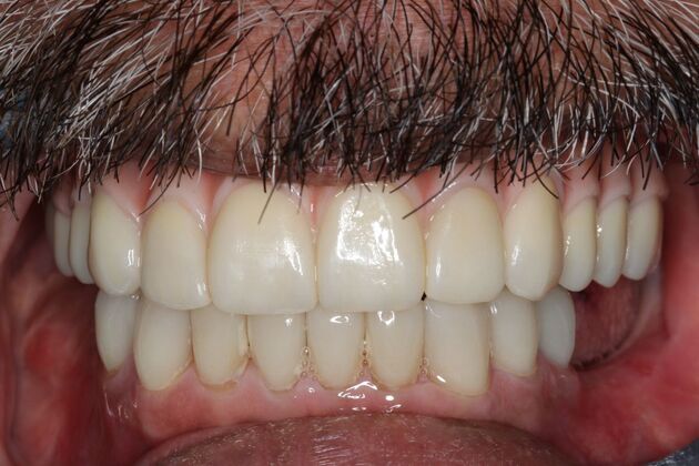 Teeth In A Day: Case 25 - After