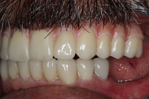 Teeth In A Day: Case 25 - After