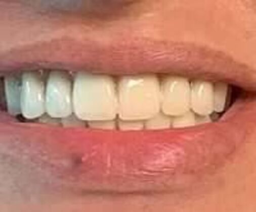 Upper & Lower Denture Case 1 - After