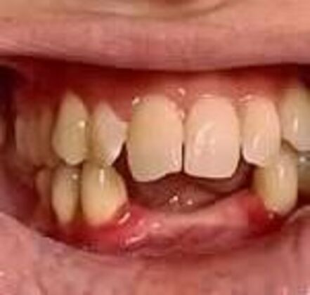 Upper & Lower Denture Case 1 - Before