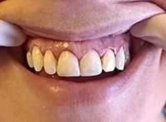 Composite Fillings: Case 1 - After