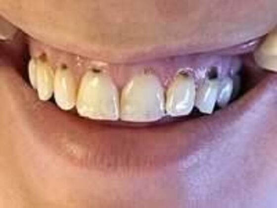 Composite Fillings: Case 1 - Before