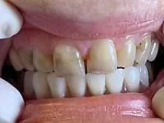 Crowns Case 1 - Before