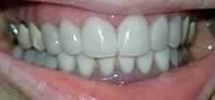 Crowns Case 1 - After