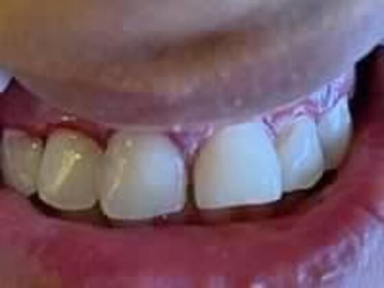 Composite Fillings Case 2 - After